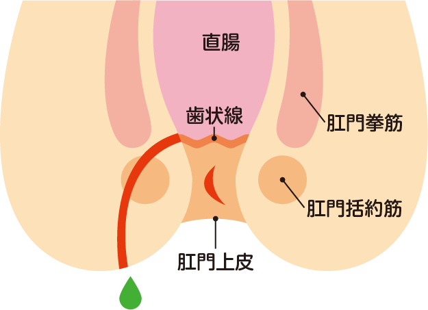 痔ろうイラスト
