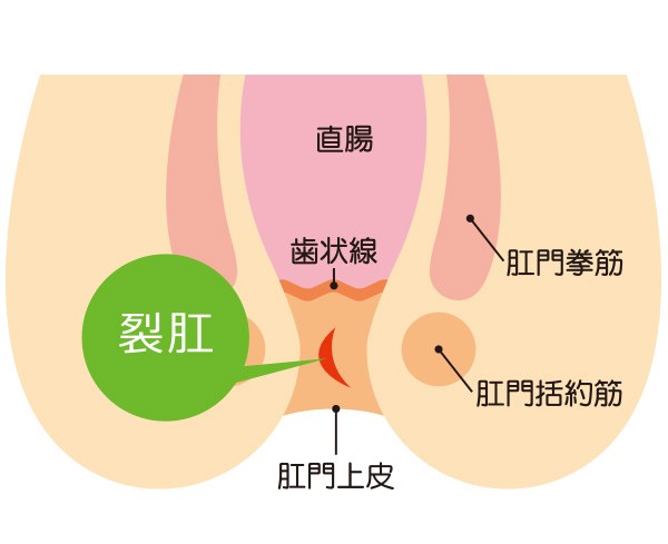 切れ痔イラスト