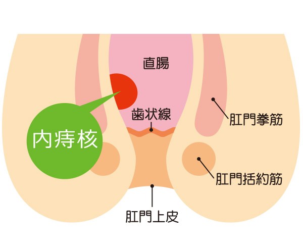 内痔核イラスト